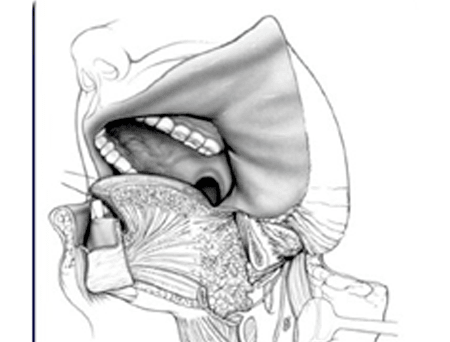 Cancer Of Buccal Mucosa